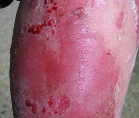 是什么原因导致红皮型牛皮癣发病的?