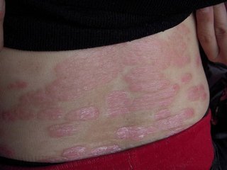 小儿为什么会得牛皮癣呢